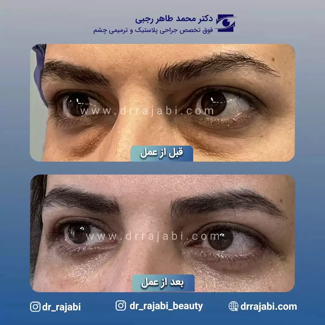 بلفاروپلاستی پلک پایین بدون بخیه | دکتر رجبی